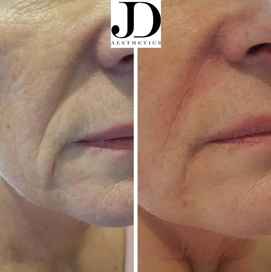 Nasal & folds 2ml Lipo Fat Freeze Specialists Manchester