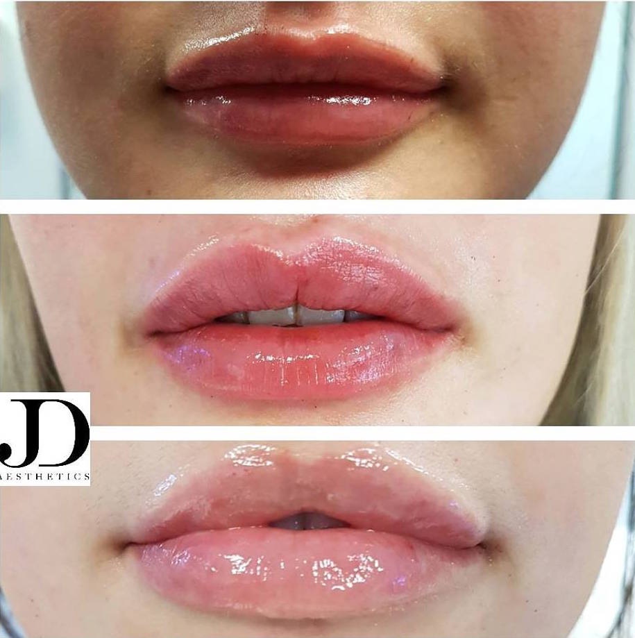 lips 1ml Lipo Fat Freeze Specialists Manchester Dermo Aesthetics